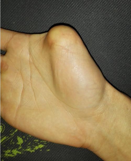 右手大拇指齐根断能考驾照吗