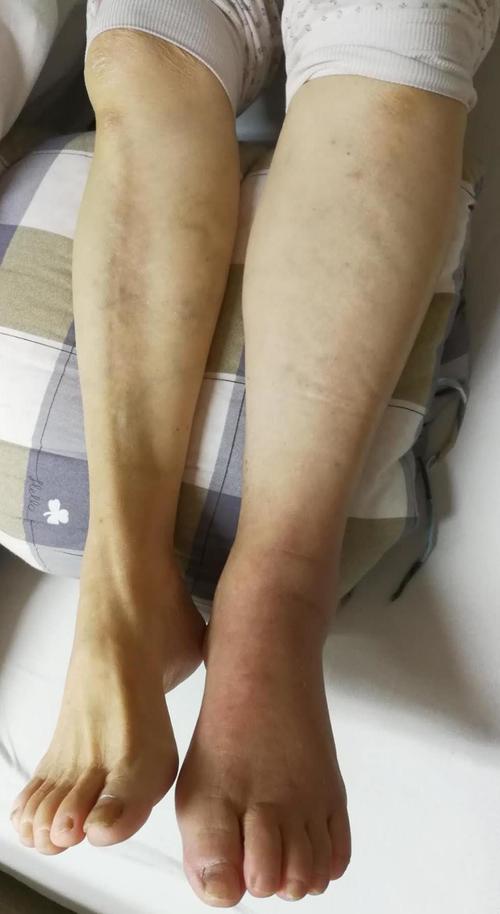 静脉血栓分深浅,两者危害太悬殊