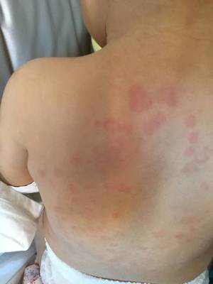 儿童神经性皮炎有什么症状