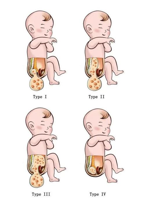 06胎儿骶尾部畸胎瘤孕期有哪些风险?