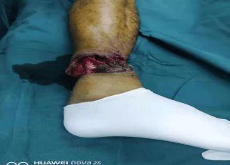 常德骨科医院成功完成一例小腿完全离断伤再植手术
