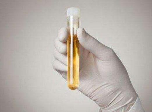 蛋白尿的原因是什么蛋白尿的症状