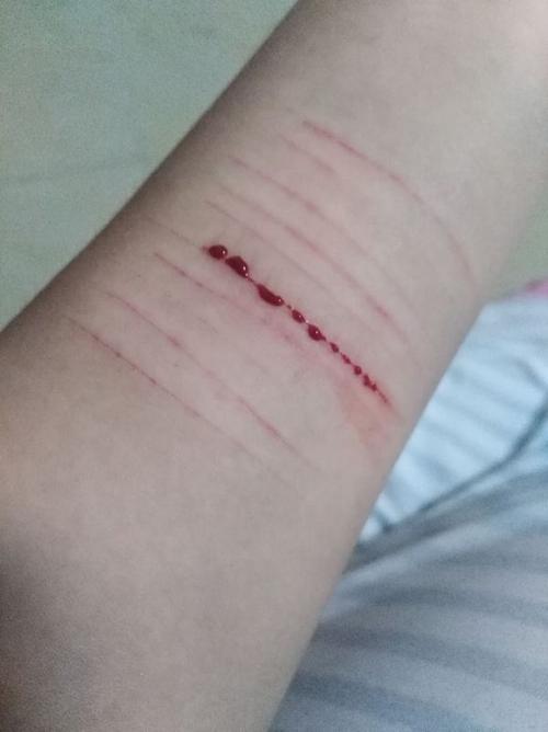 你有过自残自虐的经历吗?