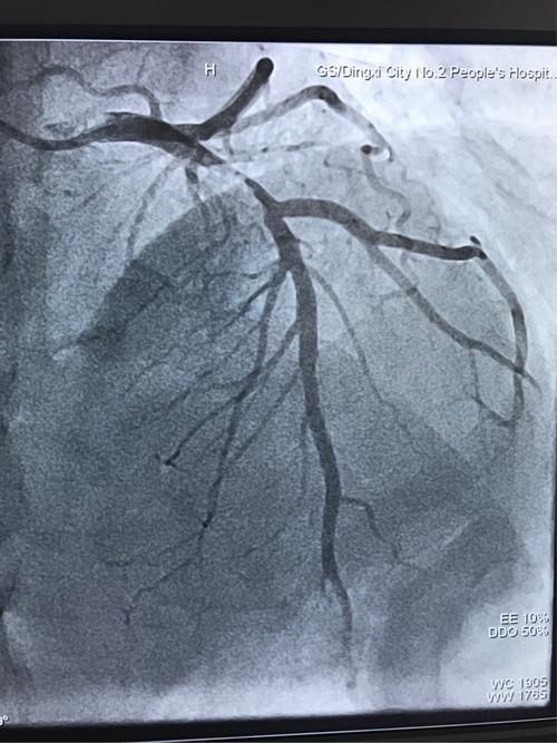 头位:前降支近段重度狭窄,血流变慢