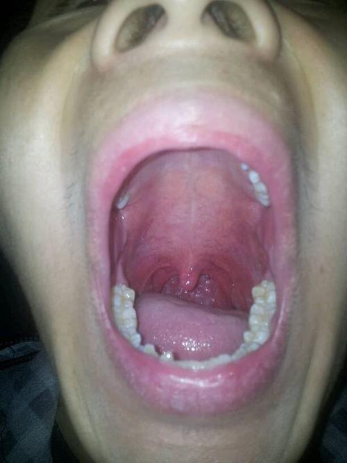 喉咙里有细细的像血管一样的正常吗?一毫米