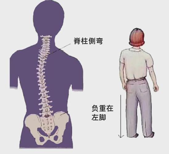 你以为的脊柱侧弯可能是假的