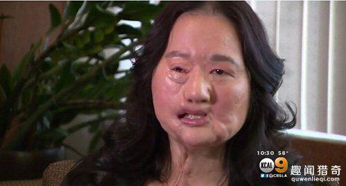 遭受家暴后她严重毁容,12年后样子实在太恐怖!