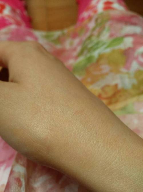 手被邻居家出生不到一年的狗咬啦一下,没出血,但有牙印!会不会得狂