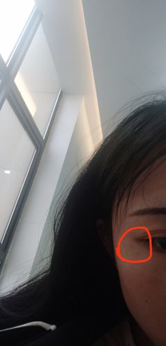 眼角下变出现了斑怎么办如图