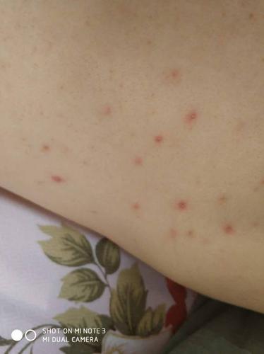 背部起了很多小红点怎么回事