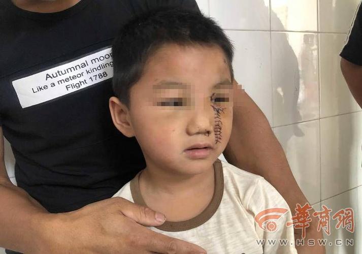 西安5岁娃面部缝16针想祛疤家里无力承担 暖心医生:我