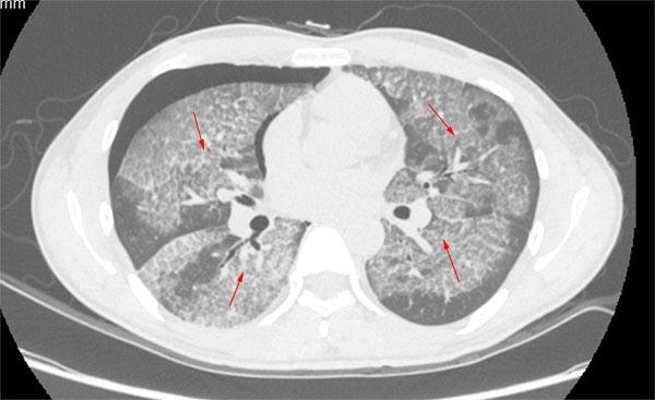 【呼吸科】全肺灌洗术是治疗肺泡蛋白沉积,尘肺矽肺的