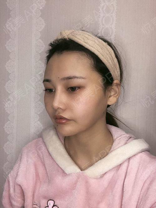 磨下颌角术后90天_颧骨颧弓整形术术后90天_颧骨颧弓整形术后90天_磨