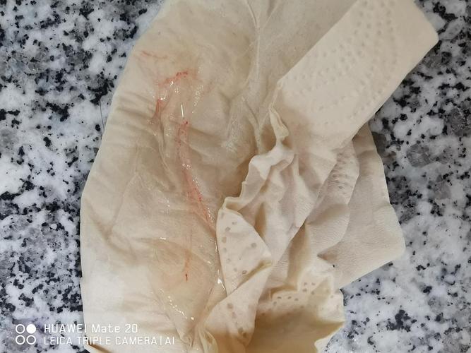 白带有血丝,是什么病阿