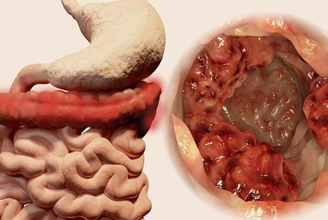 溃疡性结肠炎好发于结肠的部位?