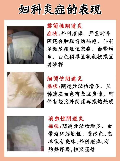 细菌性阴道炎终于治好啦!