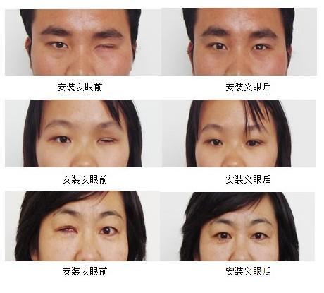 给石家庄博涵义眼研究所的河南安装假眼的专业医院