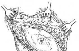 根治性乳房切除术