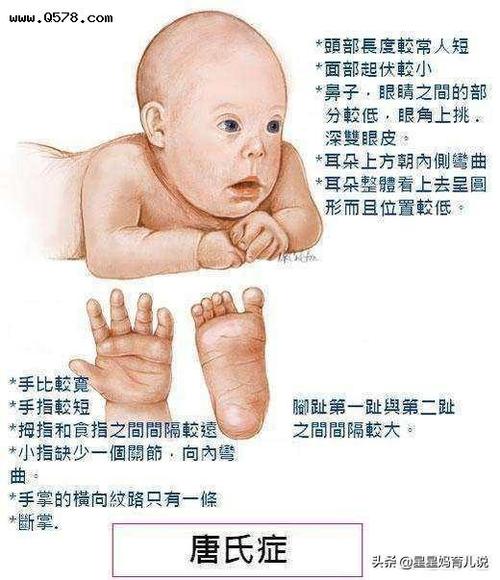 孕妈该如何避免生唐氏儿