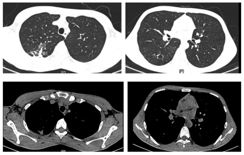 咳嗽咳痰6年,小伙吃激素竟吃出肺结核!-medsci.cn