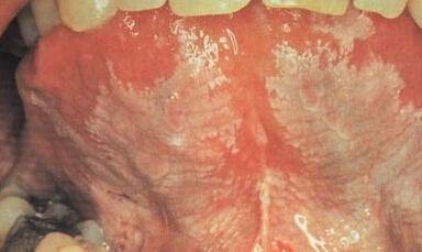 问:请问,这是毛状白斑吗? 舌头边缘那些