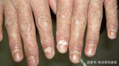 网易首页>正文申请入驻> 牛皮癣初期第四症状关节病变,除了皮肤直接会