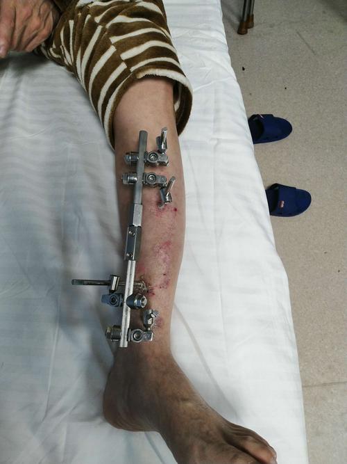 术前患者左小腿照片