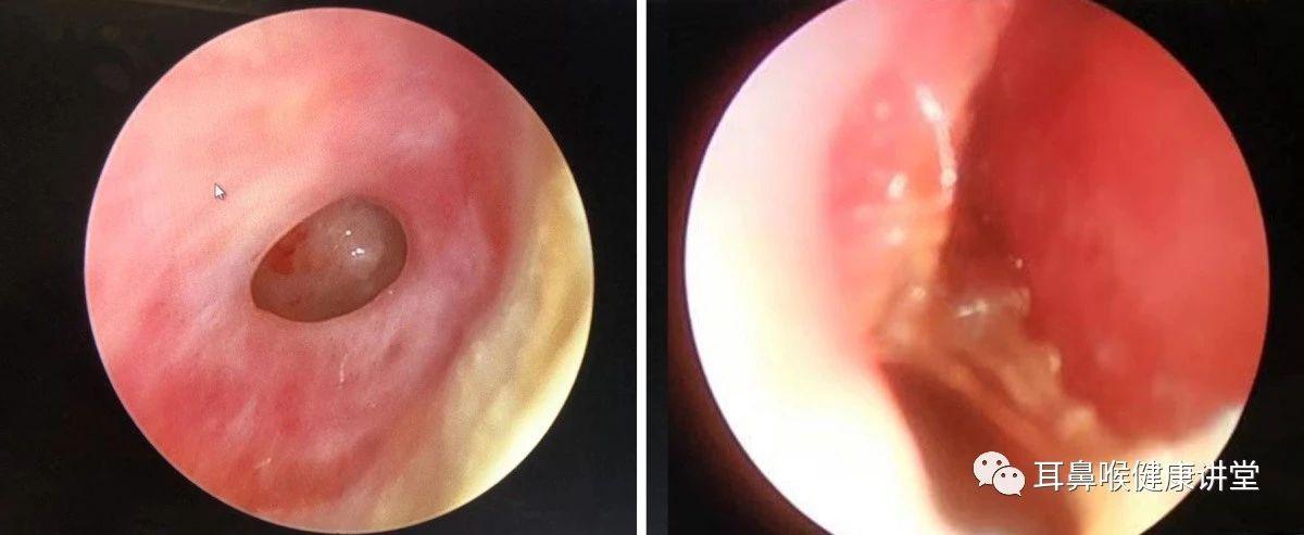 耳朵内的鼓膜穿孔是什么样的,点进查看_外耳道