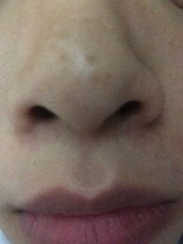 鼻头突然长斑,怎么办?