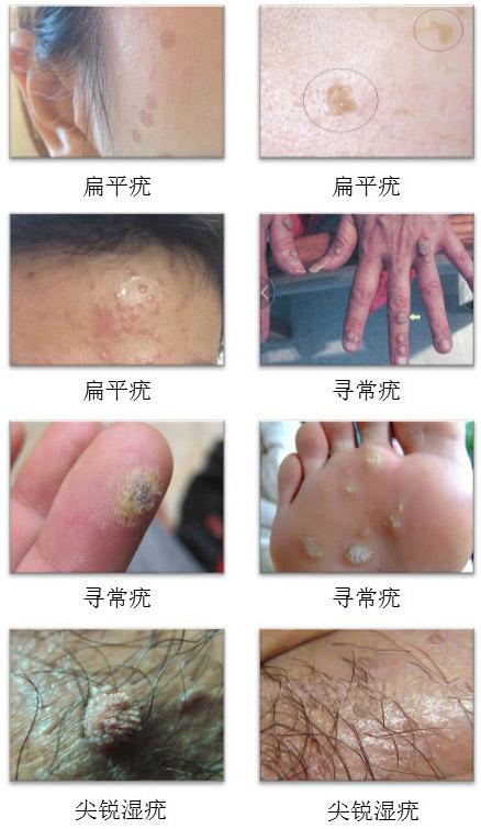 根据临床表现和部位分为:寻常疣,扁平疣,跖疣,生殖器疣(尖锐湿疣)