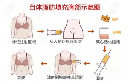 隆胸 > 我小a胸想做自体脂肪丰胸,在甘肃张掖市做的话价格大概多少钱?