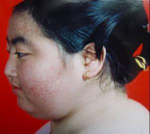 尤其要警惕: (1)向心性肥胖,水牛背,锁骨上脂肪垫;满月脸,皮肤薄,瘀斑