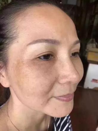 35岁满脸斑怎么办?娇碧泉助您3天淡斑