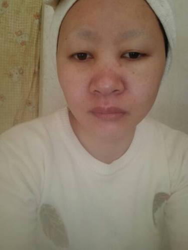 你好,本人原来有慢性肾炎,现在脸上跟头上都肿要看什么科呢?