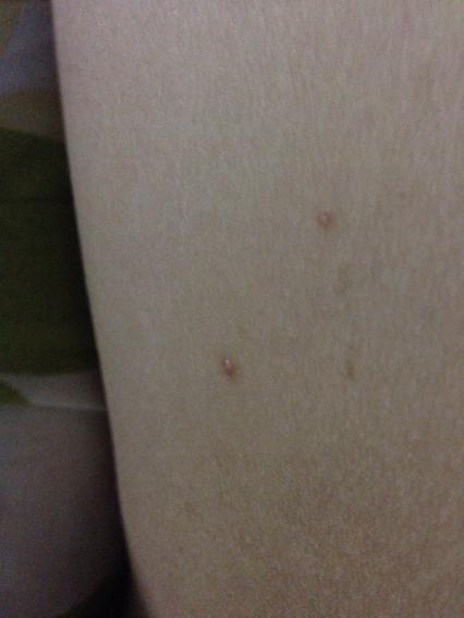 谁知道这个是什么,长在大腿根部,一星期多了,好像有变多起来,会不会是