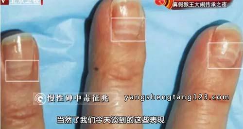 我是大医生2016年2月4日视频,崔培林,胃癌-餐桌上的夫妻癌