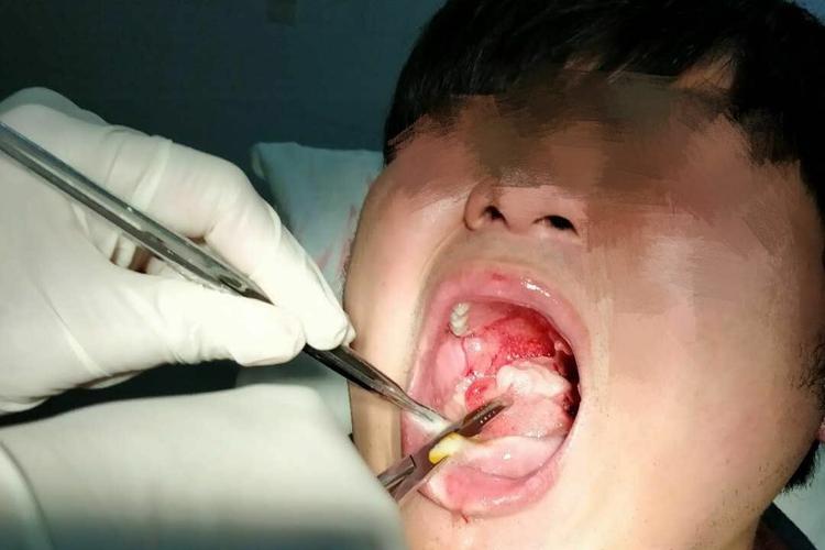 扁桃体周围脓肿切开扩张引流的手术治疗