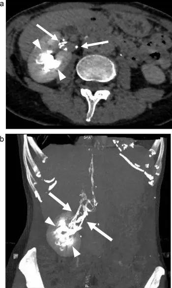 泌尿淋巴瘘与尿石症相关的1例报告