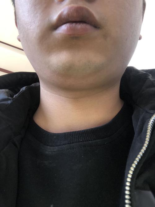 这是淋巴结肿大么