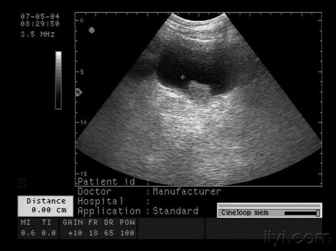 典型膀胱占位两例!(膀胱癌)