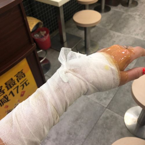 烫伤了怎么办啊啊啊_烫伤_疤痕_消炎_维c_泡面