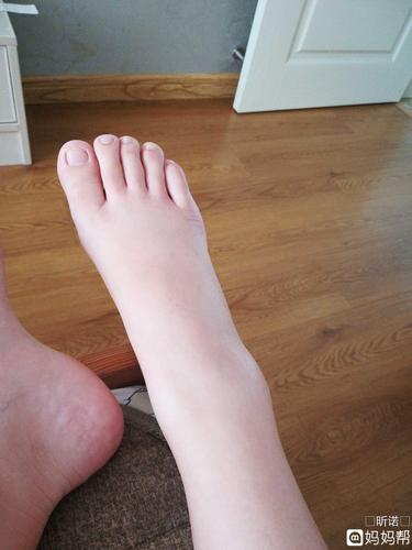 38周 1脚肿涨的难受,左脚肿的比右脚厉