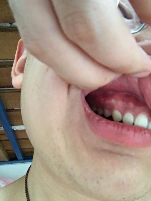 牙龈上出现白色突起,这是什么问题