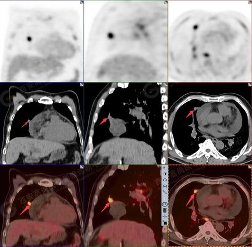 pet/ct 图像1. 以下为肺内原发灶2.