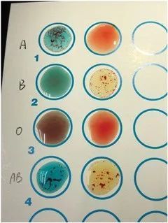 abo血型的鉴定原理abo血型鉴定和交叉配血试验3