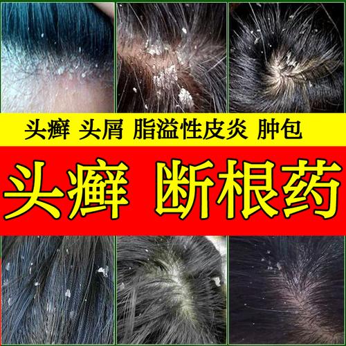 治疗毛囊炎_治疗头癣银屑病牛皮癣藓药膏真菌感染毛囊炎头皮癣头部