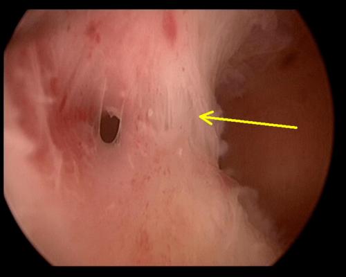 为什么每个宫腔粘连的女性都需要做宫腔镜?