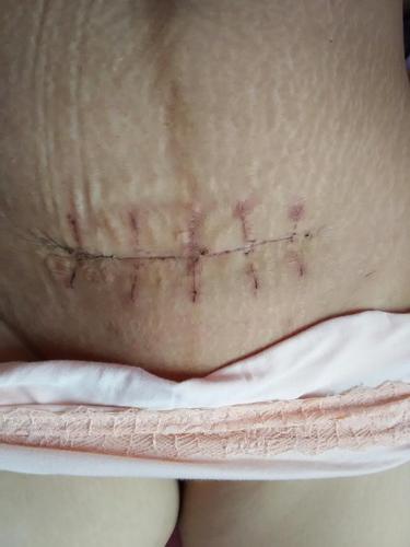 剖腹产都是几天洗澡的只看楼主