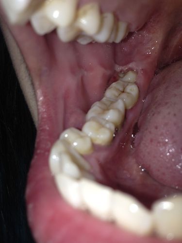 智齿发炎,我这情况是智齿冠周炎么,脸颊有点小肿,牙冠