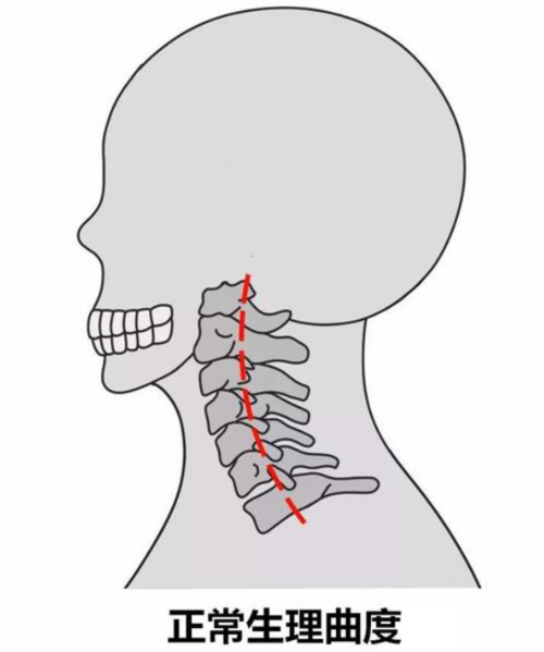 年轻人的颈椎生理曲度变直或者反曲,很可能和"低头"有关!